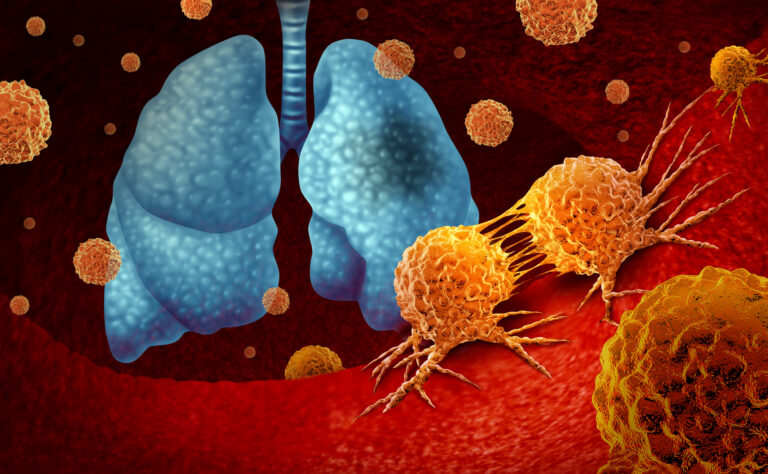 lung-cancer.jpg