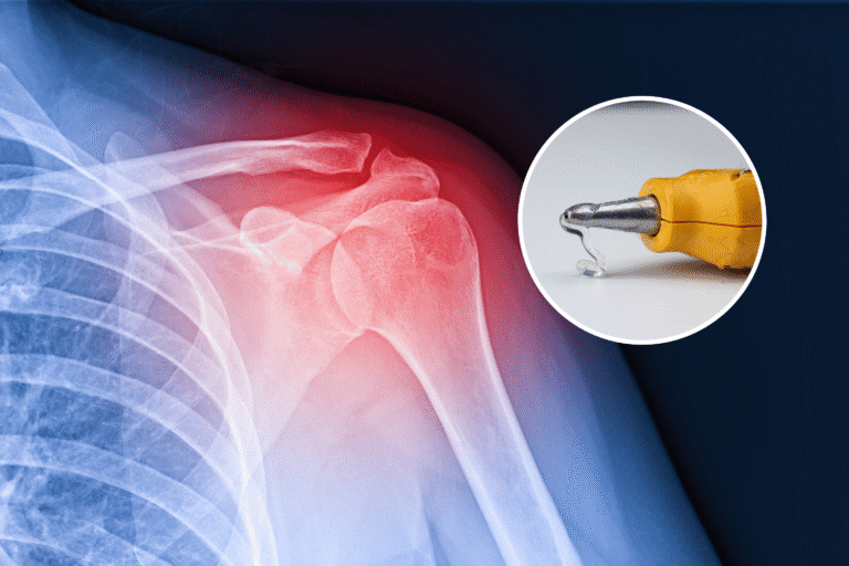 broken-bones-glue-gun.png
